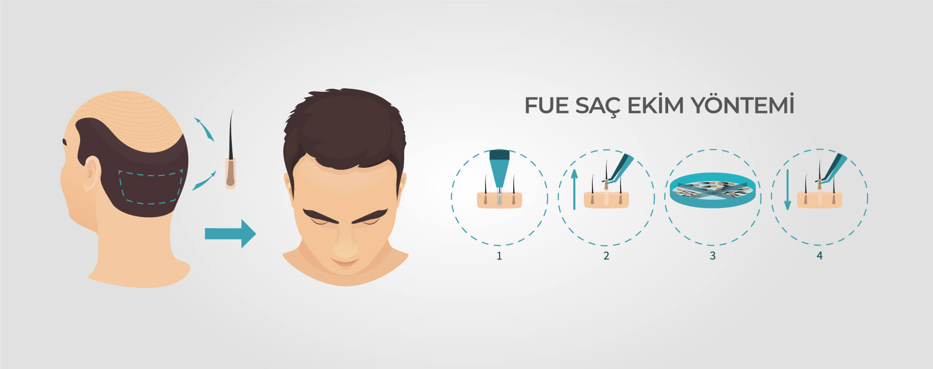 FUE-SAC-EKIMI